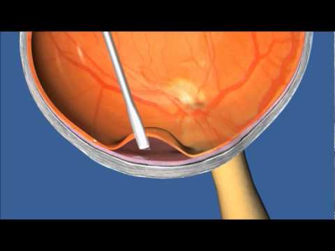 RetinalProsthesis